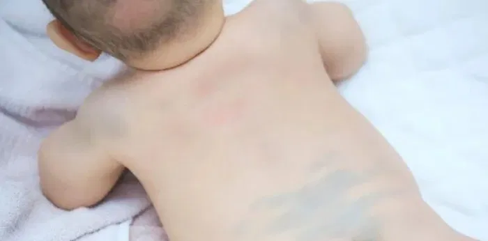 bercak biru bayi